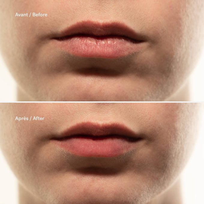 Resurfacing Lip Peel