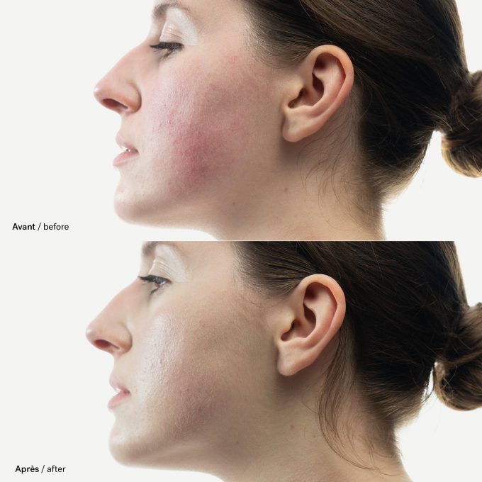 Color Corrector for Redness
