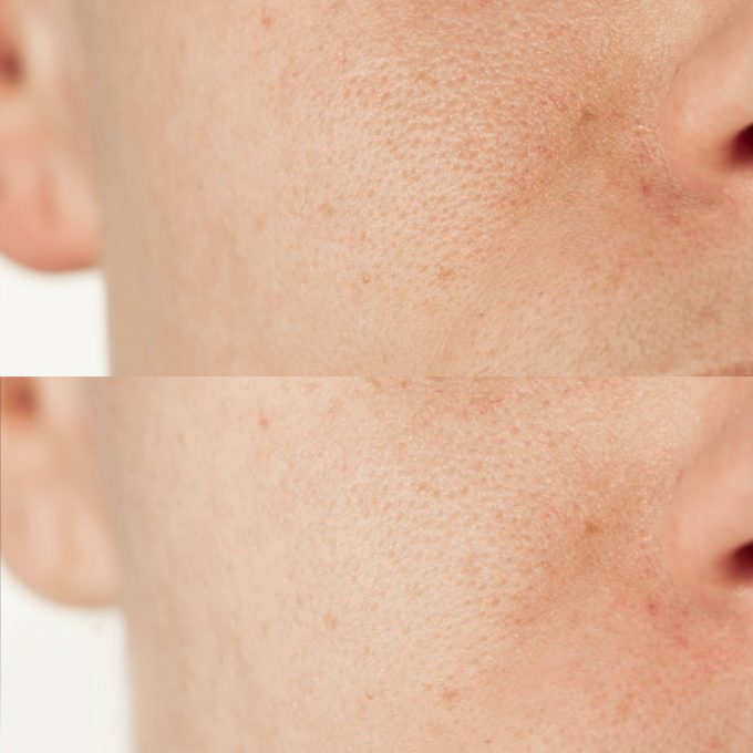 Mask for Enlarged Pores and Blackheads
